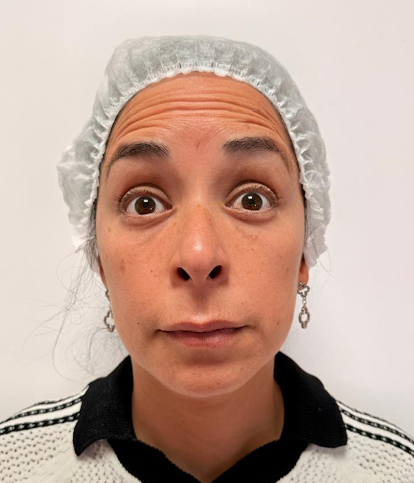 Antes: toxina botulínica